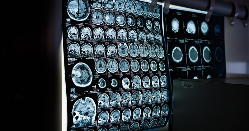 Atrophie cortico sous corticale : comprendre enfin ce qui se passe