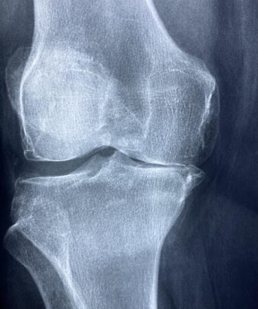 découvrez tout sur le cartilage de l'oreille : structure, fonctions, blessures courantes et soins pour maintenir la santé de votre oreille.