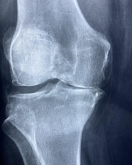découvrez tout sur le cartilage de l'oreille : structure, fonctions, blessures courantes et soins pour maintenir la santé de votre oreille.